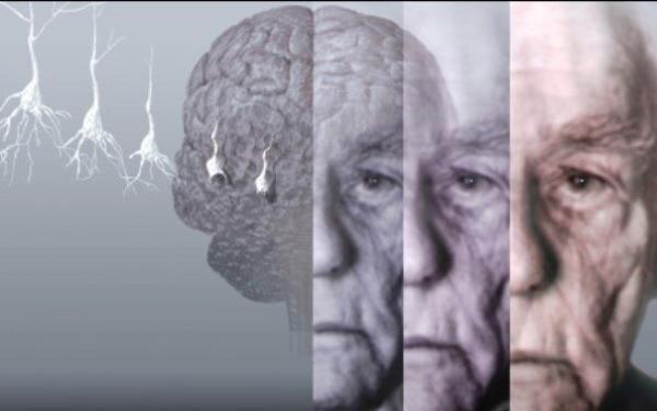 تستی برای تشخیص زودهنگام آلزایمر
