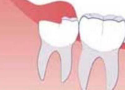 تاثیر دندان عقل بر ترتیب بقیه دندان ها