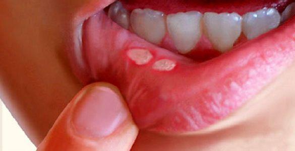 با این 9 روش سریع و خانگی، آفت دهان را درمان کن!